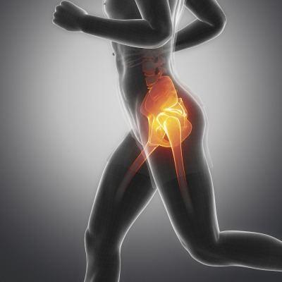 x-ray view of a dysfuncitonal hip joint that should be evaluated by a chiropractor.